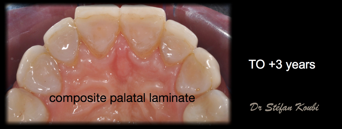 veneers and crowns /Dr Stefan Koubi